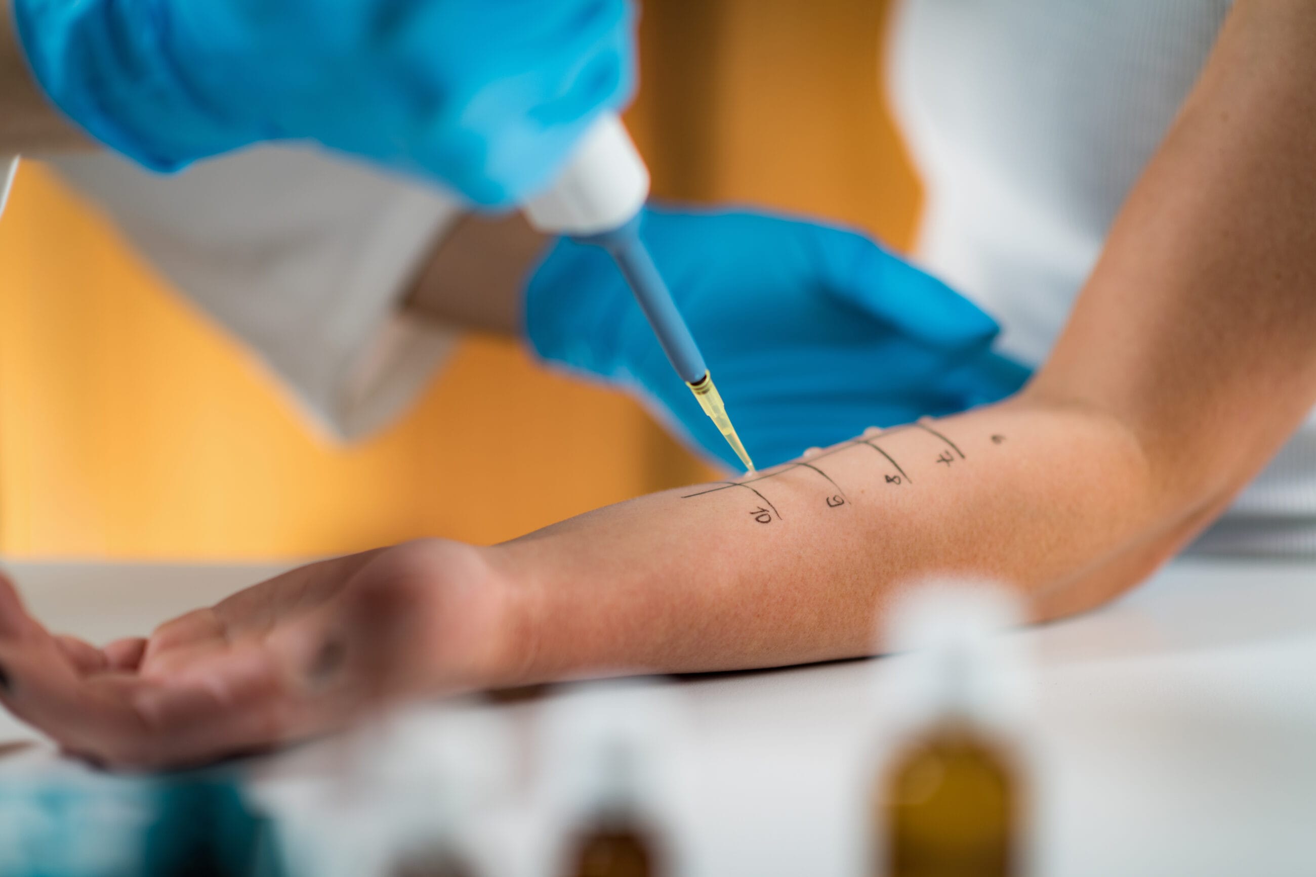 Why IgE Testing Is Important In Allergy Diagnosis