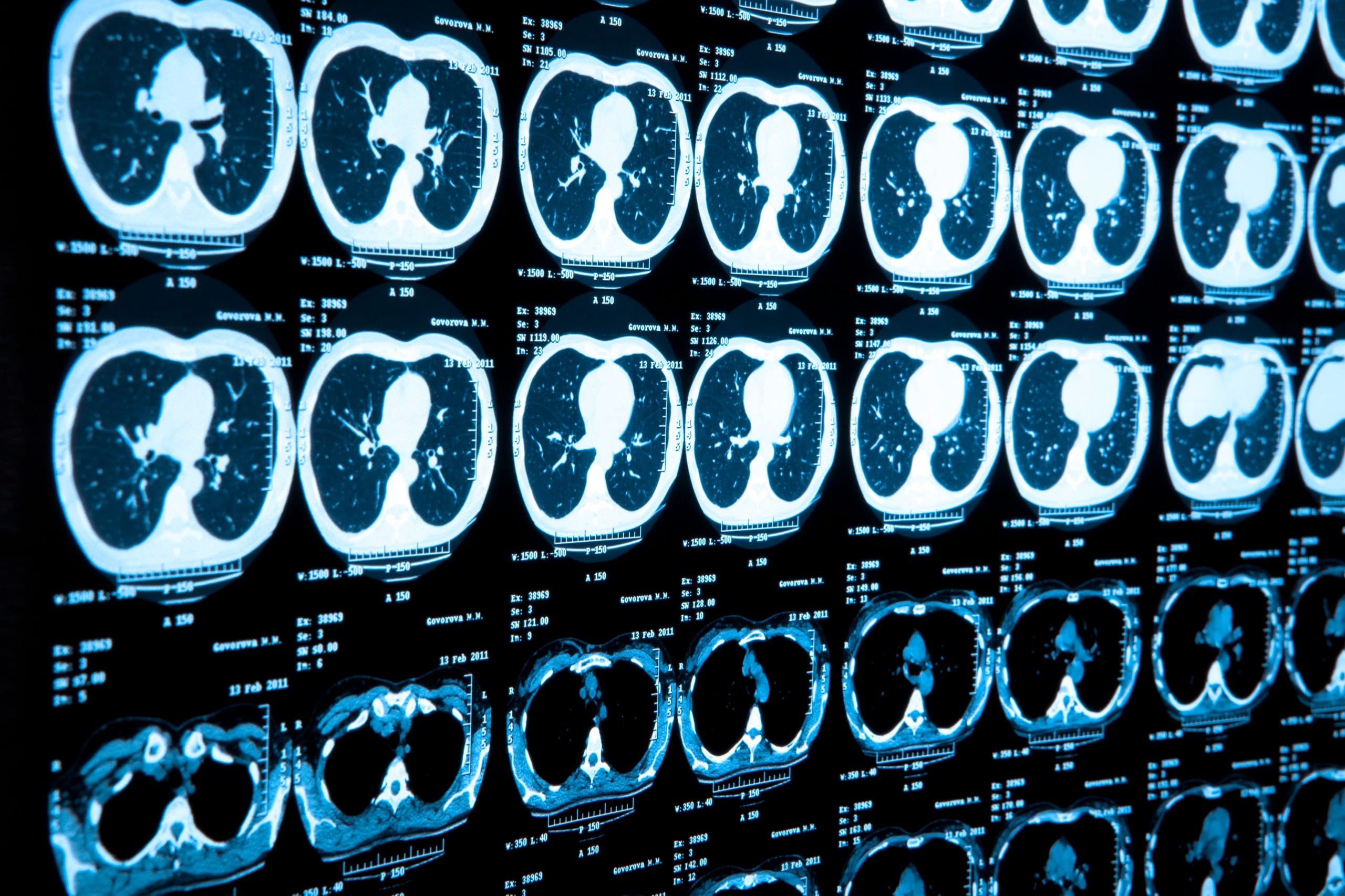 Low-Dose CT for Lung Cancer