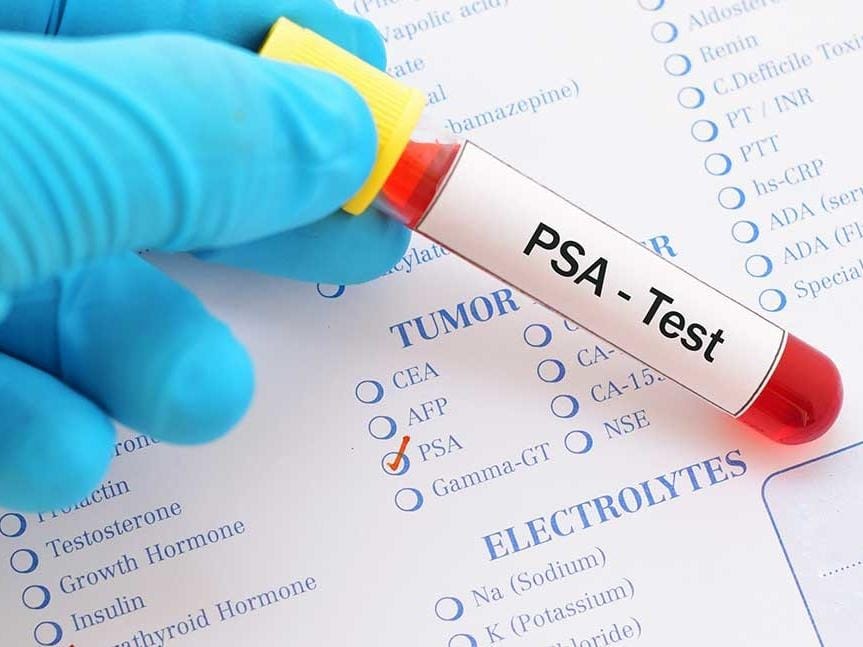 PSA Test for Prostate Cancer