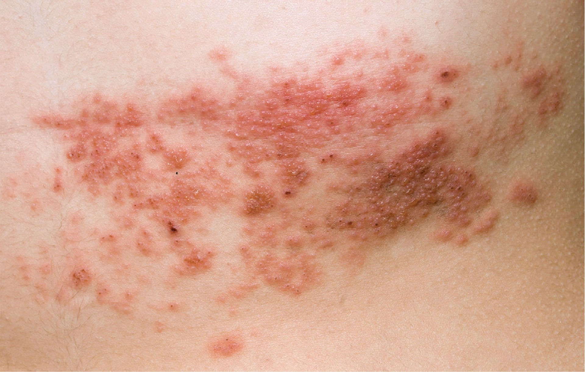 Acquired Immune Deficiency Syndrome