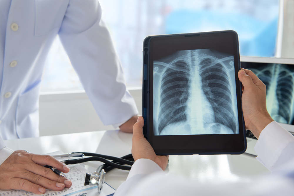 Understanding Different Types of Lung Cancer Screening