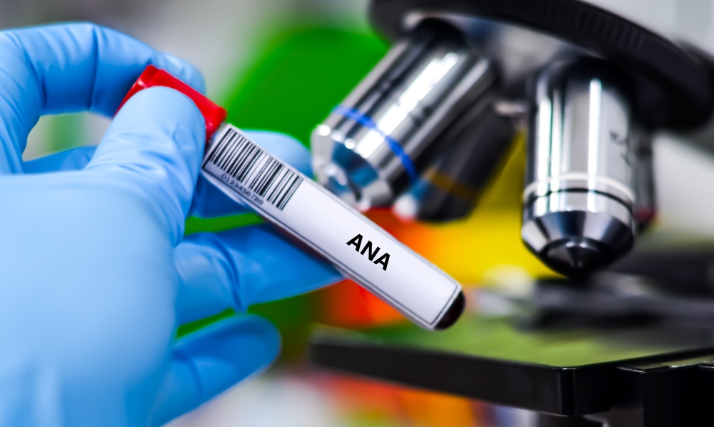 Antinuclear Antibody (ANA) Test