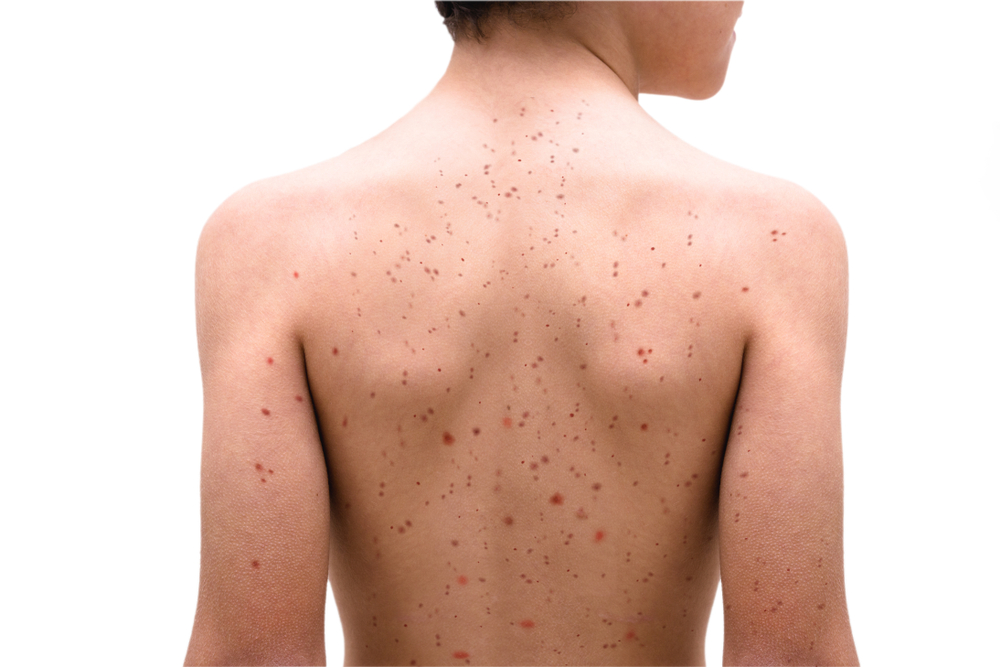 Understanding Measles and Mumps More Than Childhood Illnesses