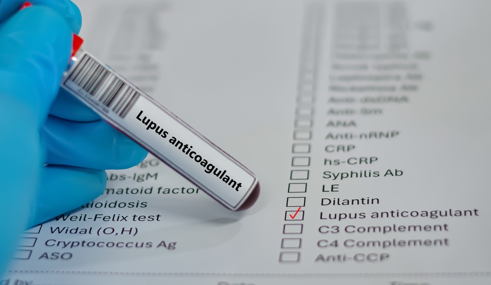 lupus screening Singapore