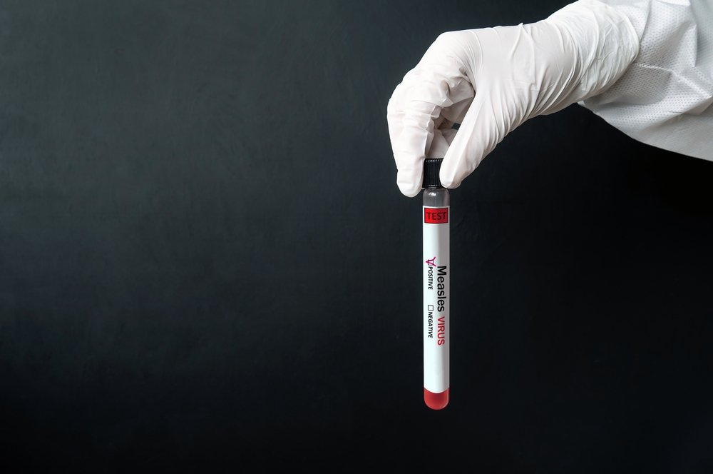 measles mumps immunity blood test Singapore